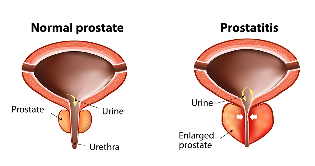 Despre prostată: cauze, tratament și beneficiile suplimentului Conprosta